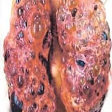 Whitmore's Disease (Melioidosis)