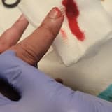 Needle and Thread (like pulling out stitches with a fork)