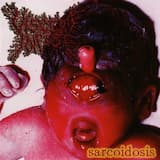 Hormona Adrenocorticotropico Purulenta