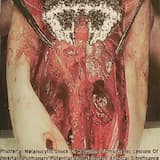 Aortic Rheumatic Stenosis / Bariatric Eppley's Cyst / Phrenodiomorfic Sacciform Fugax