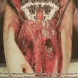 High Pressured Desquam Of Pustulosis (An Uncommon Formation Of Plheorrosa) (Obductory Re-edit)