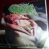 Subcortical Arteriosclerotic Encephalopathy (Binswanger's Disease)