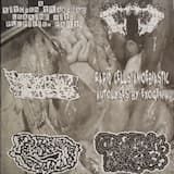 Ague-Cake Tumor (Hard Swelling On The Left Side Of The Abdomen, Lower Than The False Rib, Resultant From Enlargement Of The Spleen Or Liver) / Somatic Mutations In Somatic Exocrine Pancreatic Tumors / Gangrenous Biocyxmiostomiea