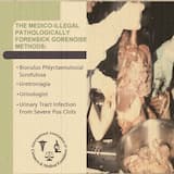 Immunohistochemistry Diagnosis For Rhabdomyosarcoma And Lymphoblastic Lymphomas and Anaplastic Large Cell Lymphomas I